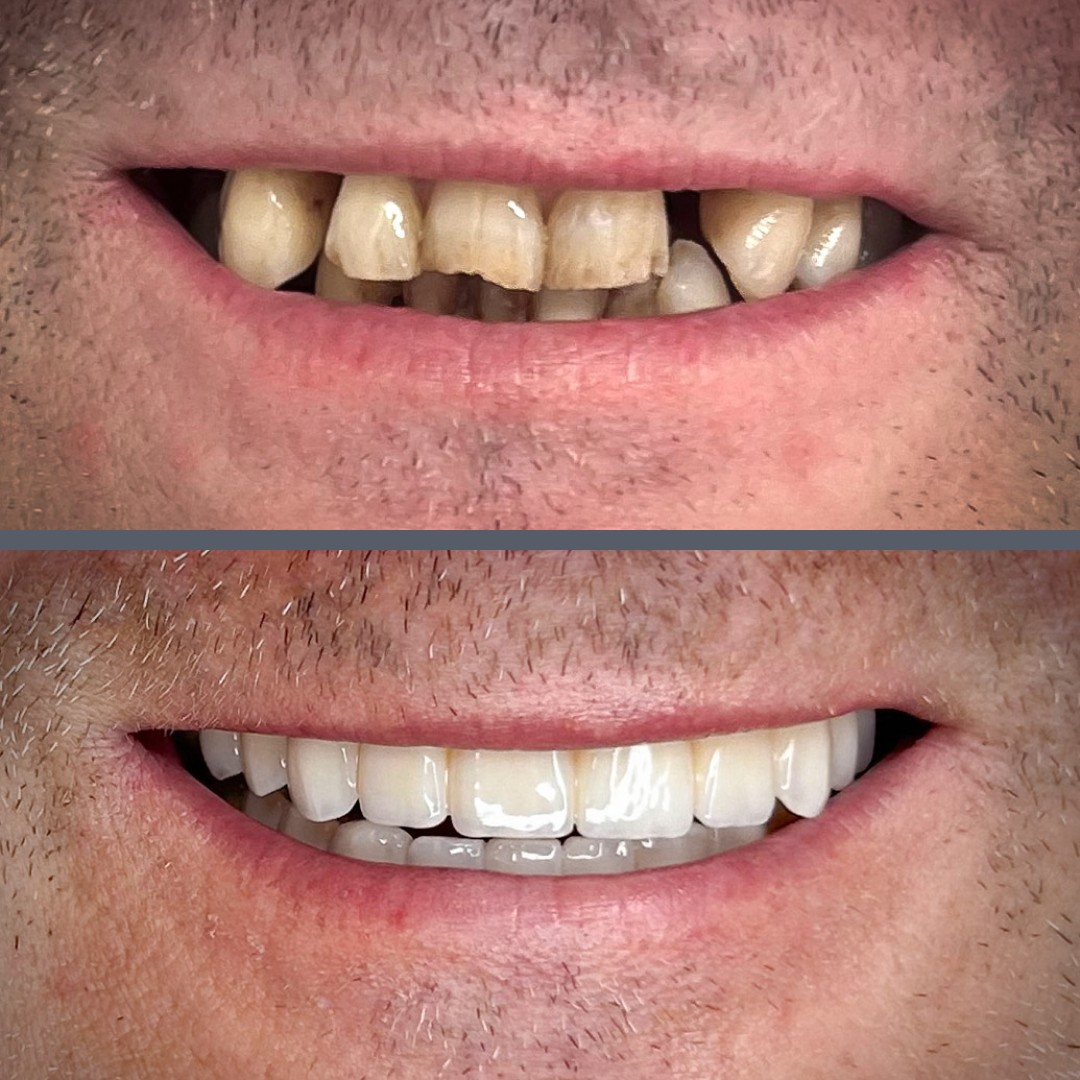 All-on-4 before-after